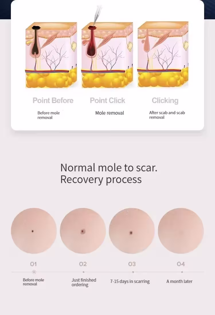 stylo plasma laser
