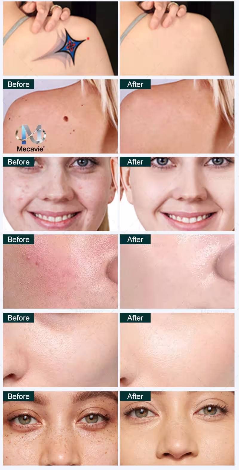 tattoo removal machine picosecond